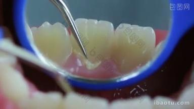 高清视频特写牙医清洁牙齿和检查与斑块去除工具